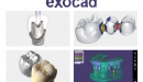 Exocad<sup>®</sup>