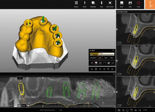 Zirkonzahn CAD/CAM Milling Implant-Planner