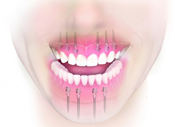3M ESPE implantační systém MDI Mini Dental Implants