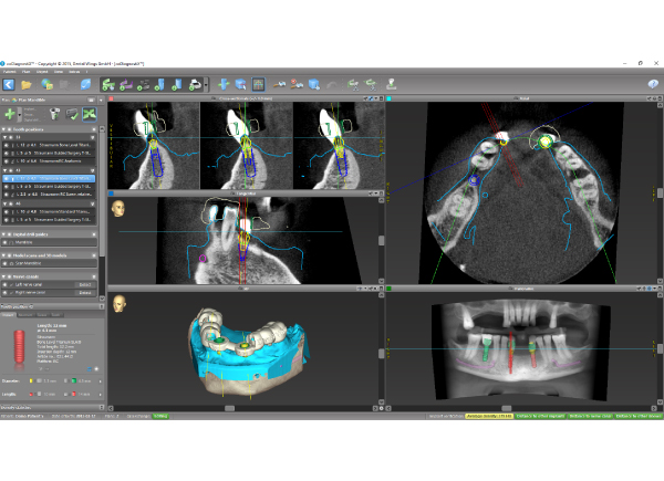 Dental Wings CAD/CAM ordinační software CoDiagnostiX