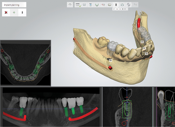 3Shape Implant Studio®