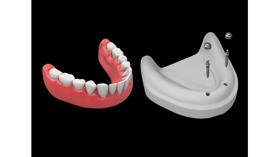 Dentium implantační systém SlimLine