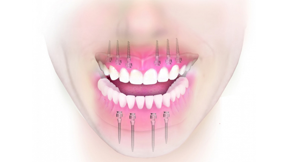 3M ESPE implantační systém MDI Mini Dental Implants