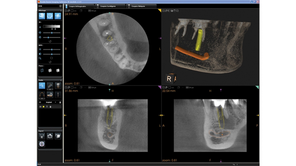 Carestream 3D CBCT rentgen CS 9000