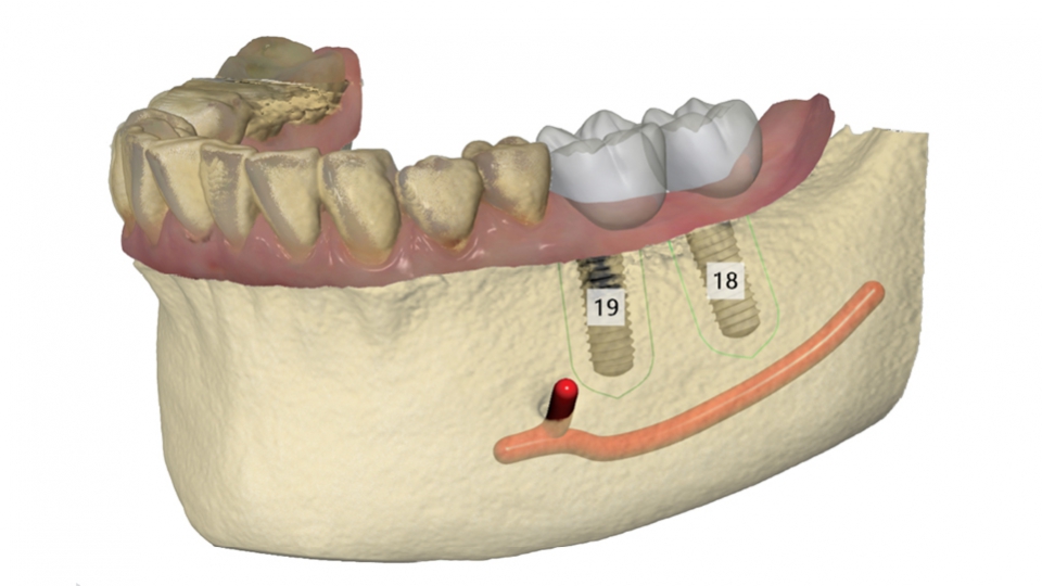 3Shape Implant Studio<sup>®</sup>