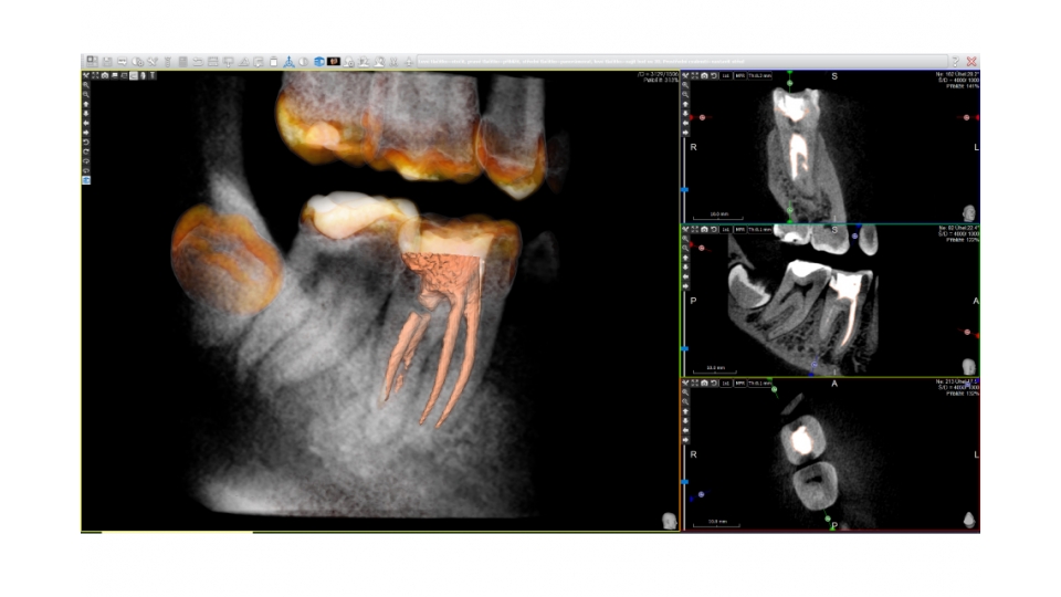 Acteon 3D CBCT rentgen X-MIND Trium 3D LOW DOSE