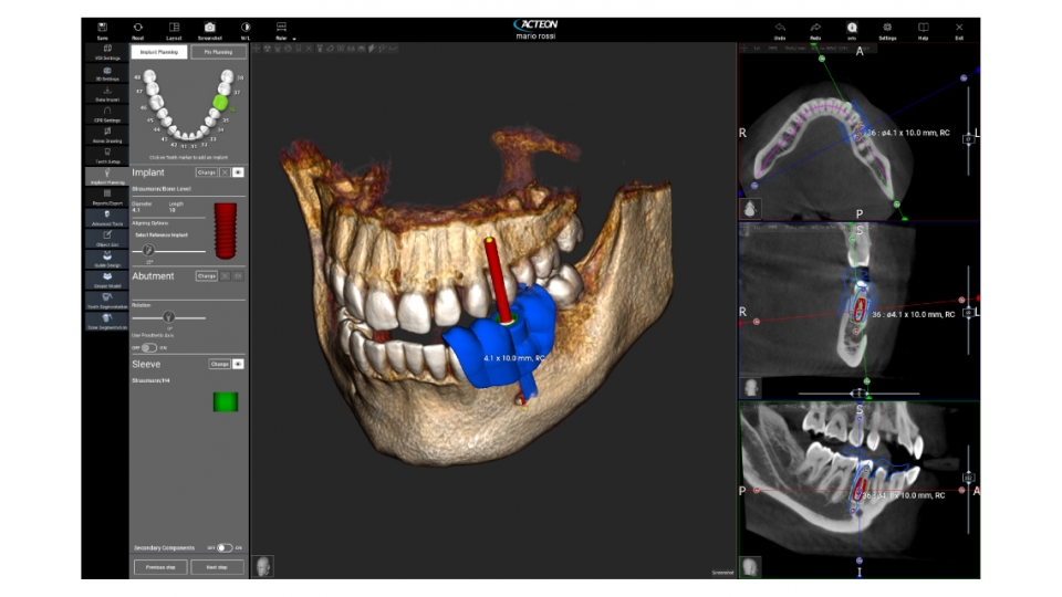 Acteon 3D CBCT rentgen X-MIND Trium 3D LOW DOSE