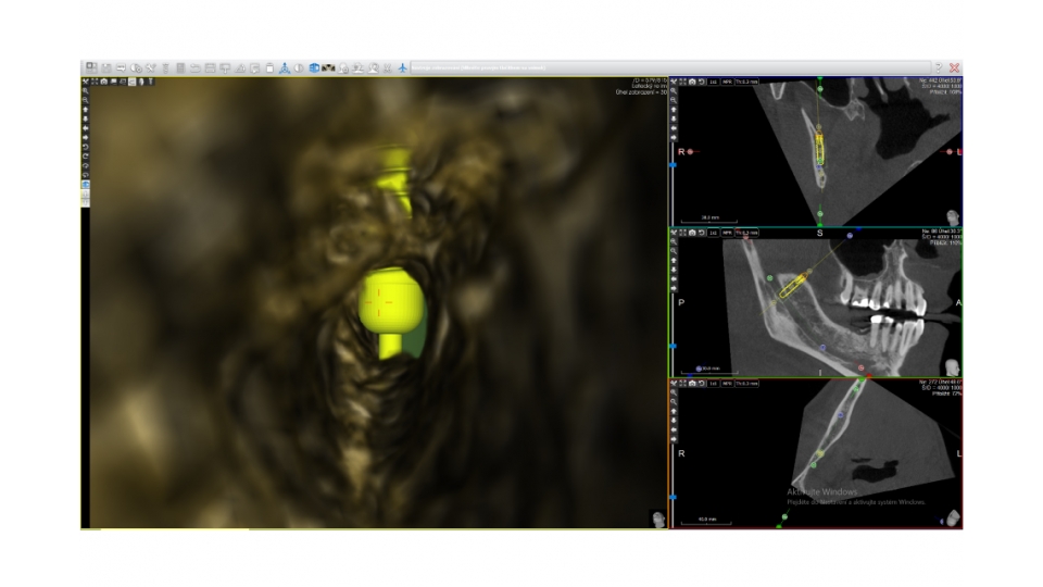 Acteon 3D CBCT rentgen X-MIND Trium 3D CEPH LOW DOSE