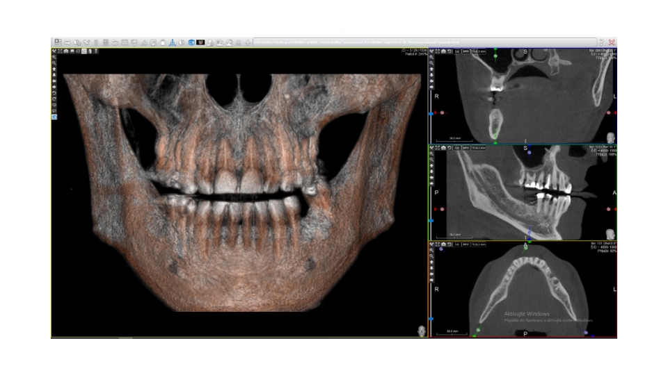 Acteon 3D CBCT rentgen X-MIND Prime 3D CEPH