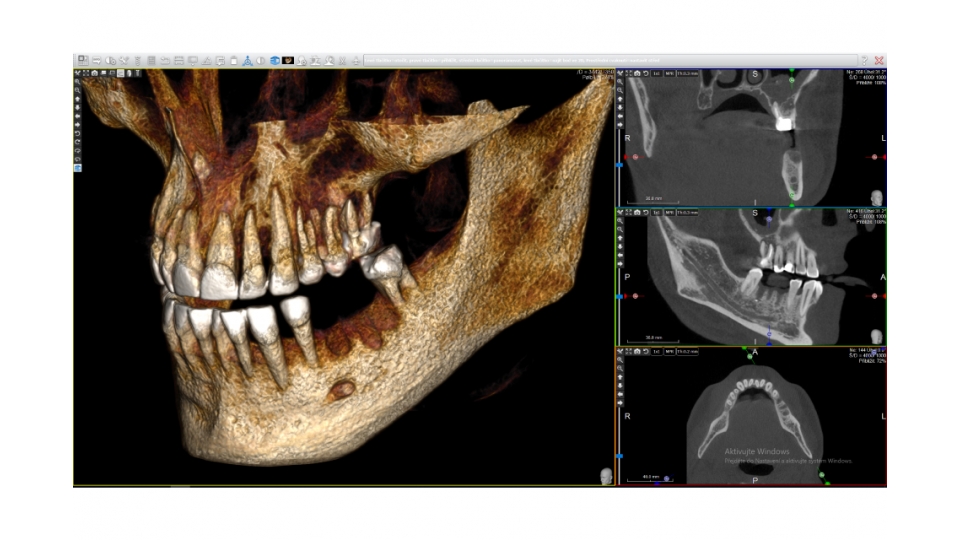 Acteon 3D CBCT rentgen X-MIND Trium 3D CEPH LOW DOSE