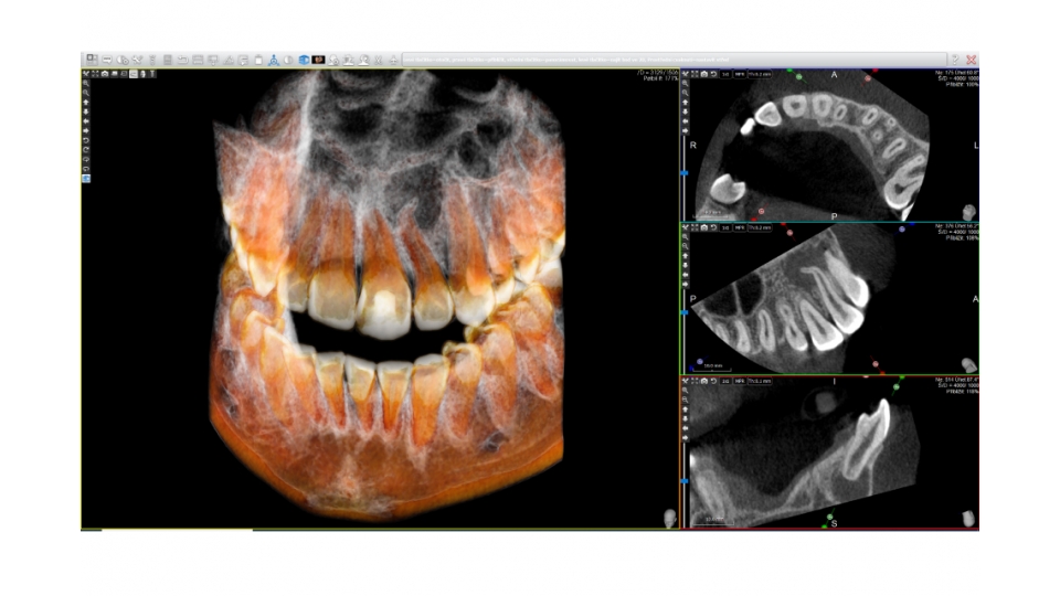 Acteon 3D CBCT rentgen X-MIND Trium 3D LOW DOSE