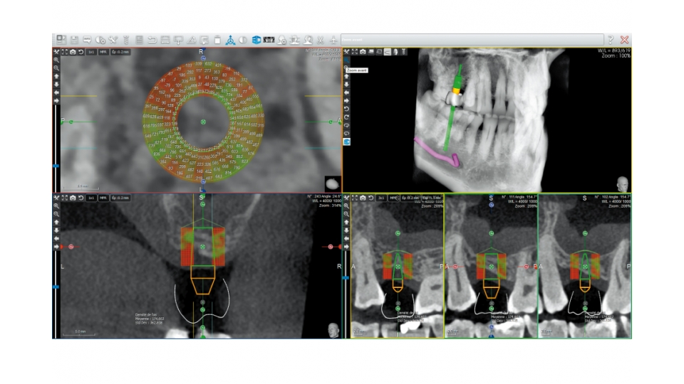 Acteon 3D CBCT rentgen X-MIND Trium 3D CEPH