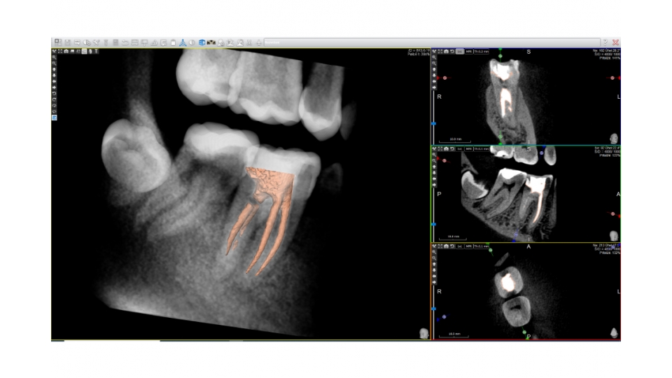 Acteon 3D CBCT rentgen X-MIND Trium 3D CEPH