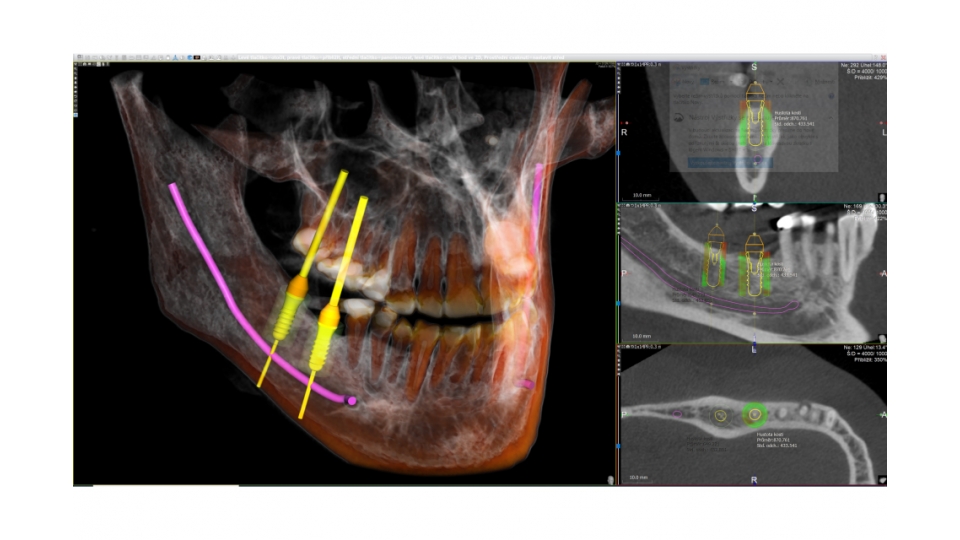 Acteon 3D CBCT rentgen X-MIND Trium 3D CEPH