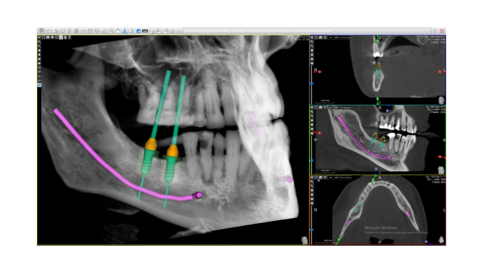 Acteon 3D CBCT rentgen X-MIND Prime 3D