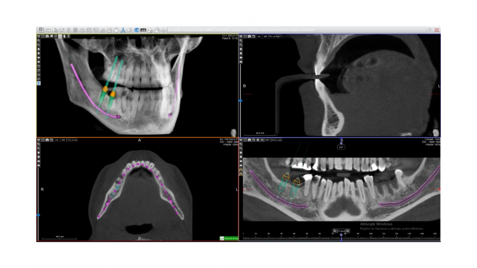 Acteon 3D CBCT rentgen X-MIND Trium 3D CEPH