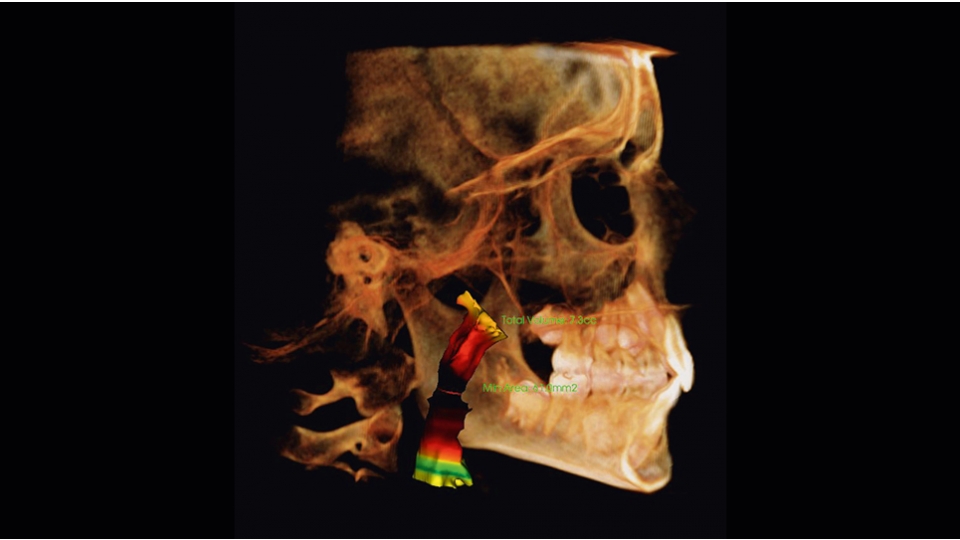 Dexis 3D CBCT retgen OP 3D Vision