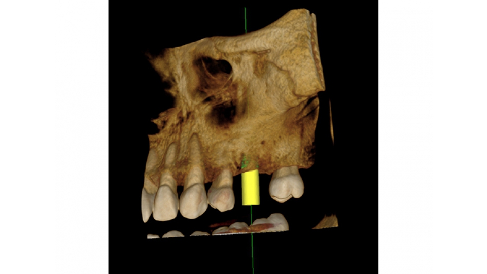 Carestream 3D CBCT rentgen CS 9300 Select / Premium