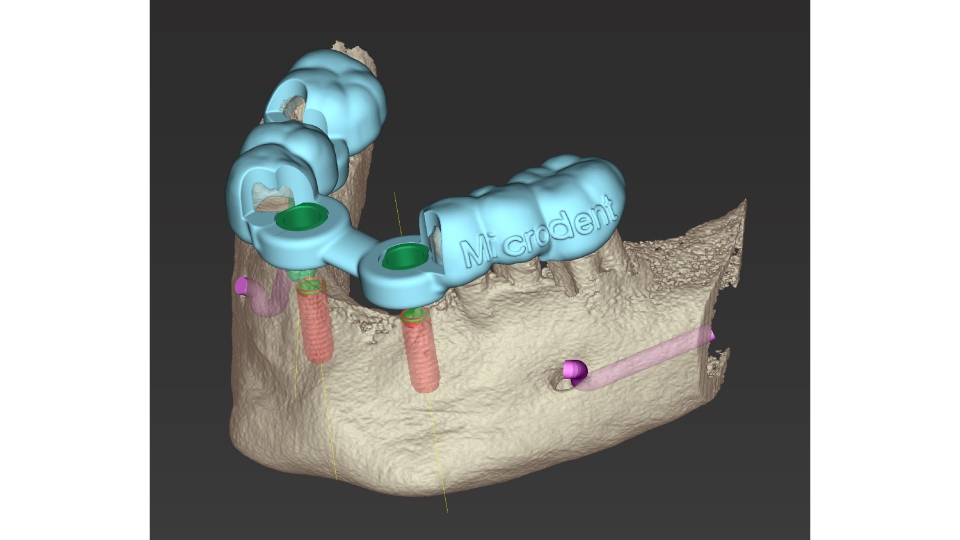 Dental Wings CAD/CAM ordinační software CoDiagnostiX