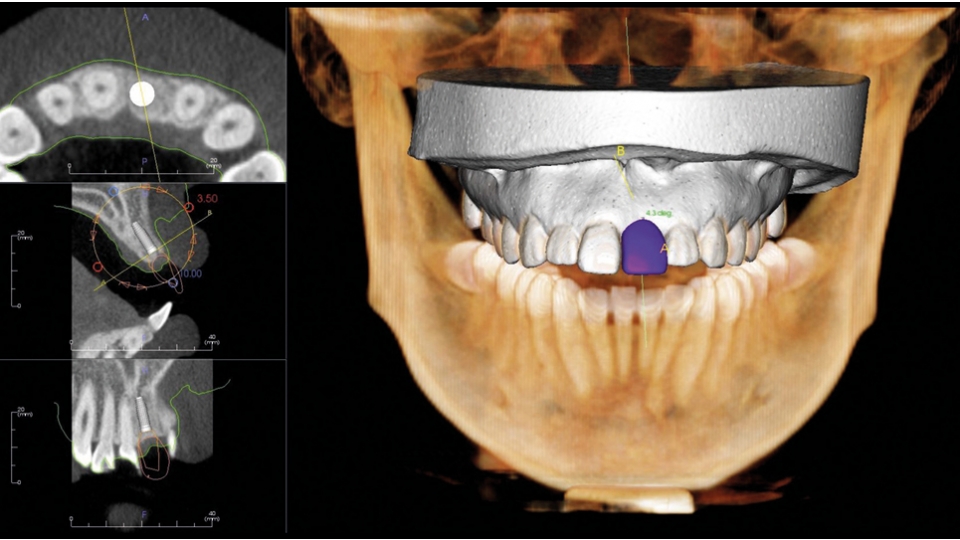 Dexis 3D CBCT retgen OP 3D Vision