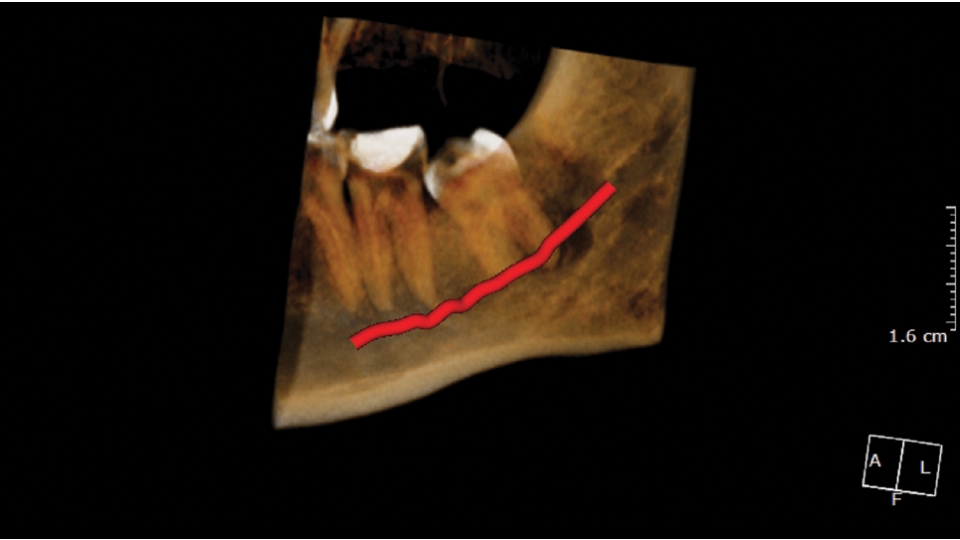 KaVo 3D CBCT rentgen OP 3D