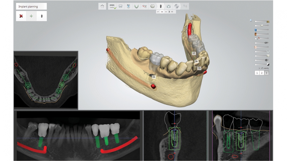 3Shape Implant Studio<sup>®</sup>