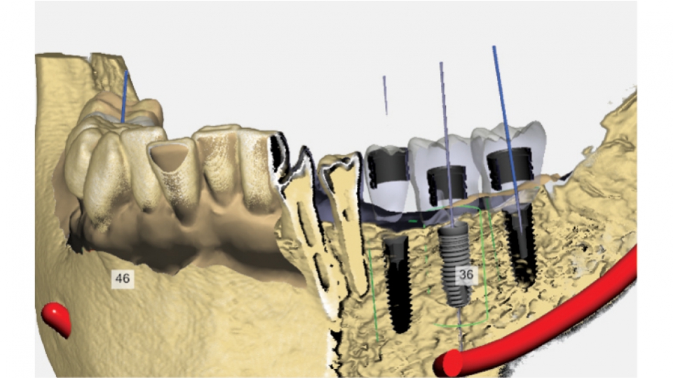 3Shape Implant Studio<sup>®</sup>