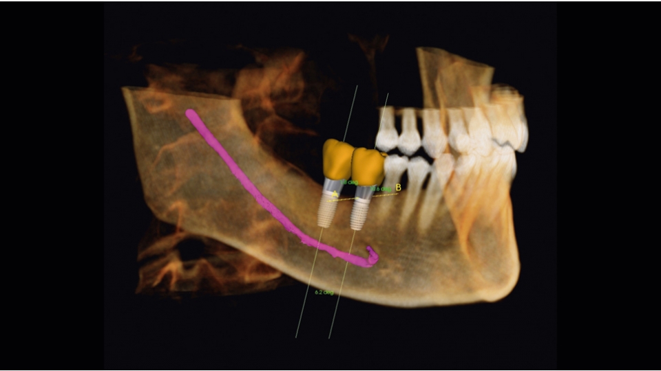 Dexis 3D CBCT retgen OP 3D Vision