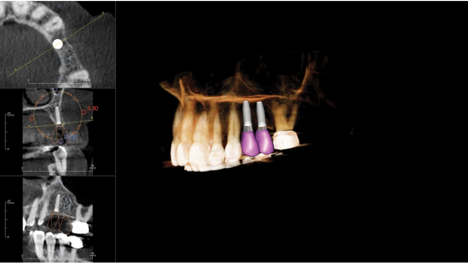 KaVo 3D CBCT rentgen OP 3D