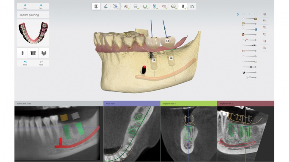 3Shape Implant Studio<sup>®</sup>