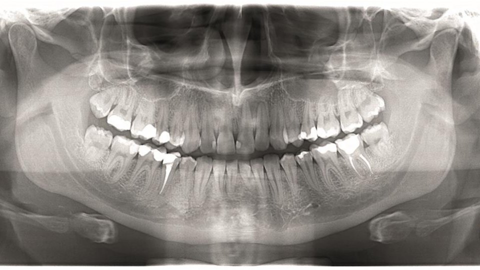 Dexis panoramatický rentgen OP 2D