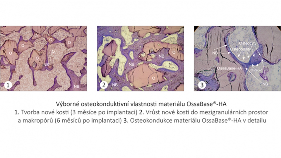 LASAK náhradní kostní materiál OssaBase<sup>®</sup>-HA