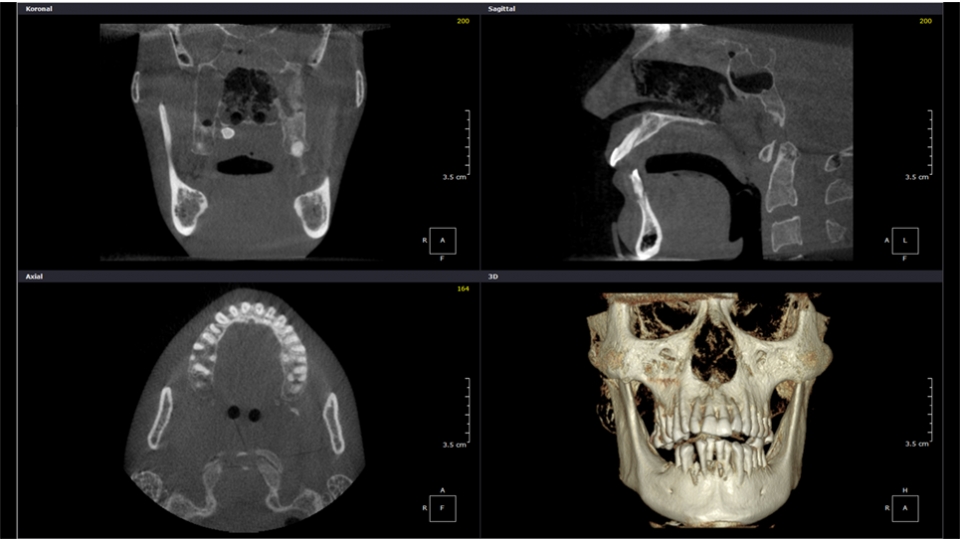 Dexis 3D CBCT retgen OP 3D Vision