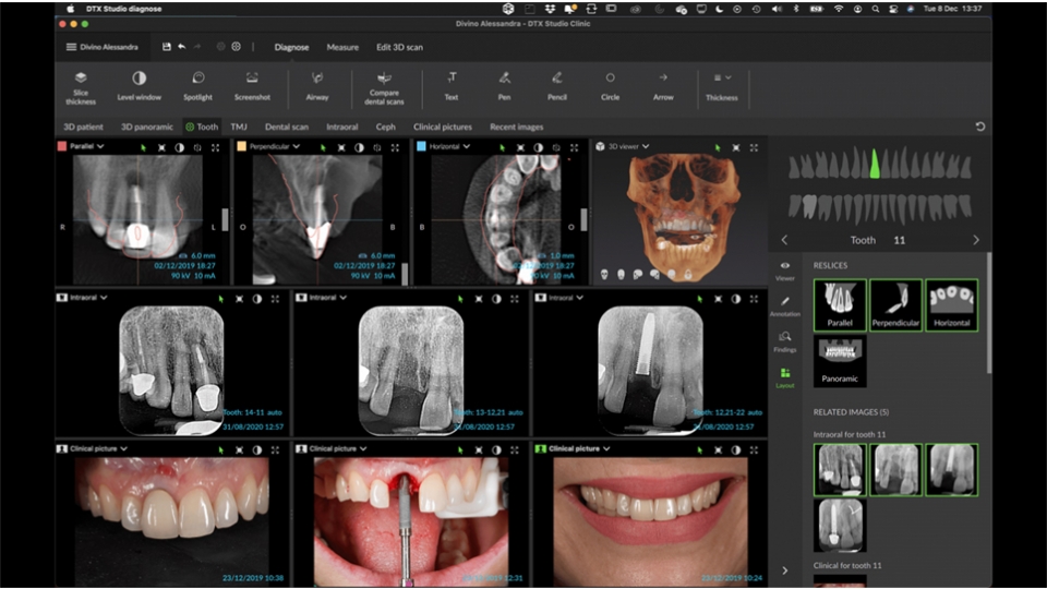 Dexis 3D CBCT retgen OP 3D