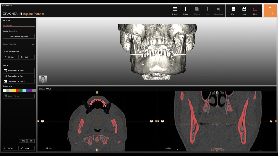 Zirkonzahn CAD/CAM Milling Implant-Planner