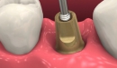 3inOne abutment