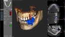 Acteon 3D CBCT rentgen X-MIND Prime 3D