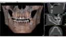 Acteon 3D CBCT rentgen X-MIND Prime 3D