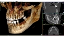 Acteon 3D CBCT rentgen X-MIND Trium 3D CEPH LOW DOSE