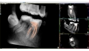 Acteon 3D CBCT rentgen X-MIND Prime 3D