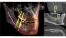 Acteon 3D CBCT rentgen X-MIND Prime 3D