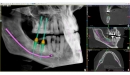 Acteon 3D CBCT rentgen X-MIND Trium 3D CEPH LOW DOSE