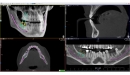 Acteon 3D CBCT rentgen X-MIND Trium 3D