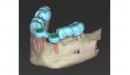 Dental Wings CAD/CAM ordinační software CoDiagnostiX