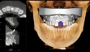 KaVo 3D CBCT rentgen OP 3D Vision