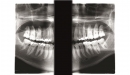 Dexis panoramatický rentgen OP 2D