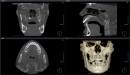 Dexis 3D CBCT retgen OP 3D Vision